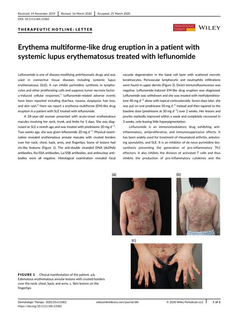 Erythema Multiforme Like Drug Eruption In A Patient With Systemic Lupus