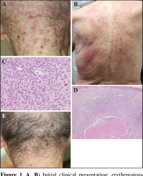 Figure 1 From Disseminated Granulomatous Skin Lesions Associated With