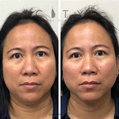 Nyc Threadlift Before And After Pictures New York Ues
