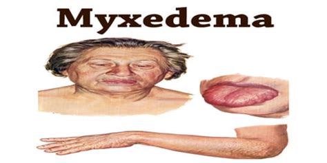 Myxedema Assignment Point