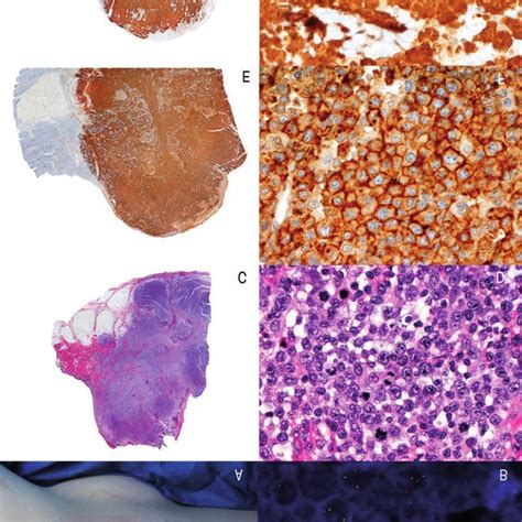 Alk Positive Primary Cutaneous Anaplastic Large Cell Lymphoma A