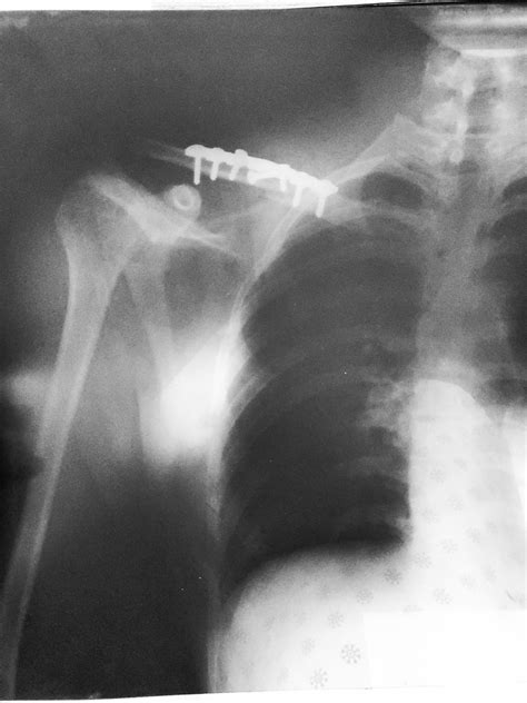Fractured Clavicle Got A Metal Plate And 7 Screws Rnamethisthing