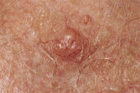 Basal Cell Carcinoma Pictures