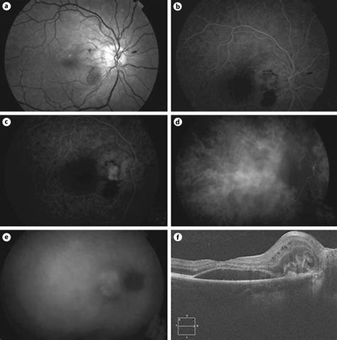 Fa Icg Angiography And Oct Of The Right Eye After Uneventful Delivery