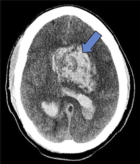 Large Intracerebral Hemorrhage With Ventricular Extension And Vasogenic