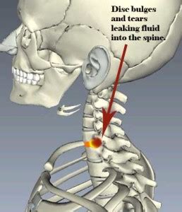 How do you know if you have a slipped disc. What To Do When You "Throw Your Neck Out": Applying Pain ...