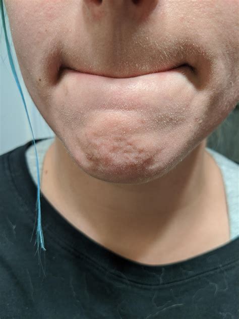 Skin Concerns How Do I Get Rid Of These White Things On My Chin I