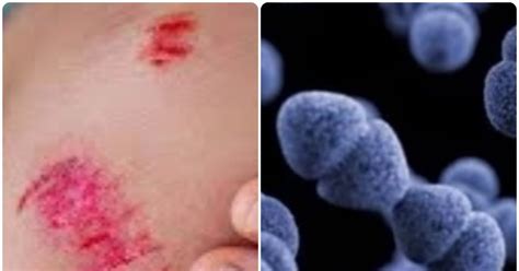 How Does The Flesh Eating Vibrio Vulnificus Bacteria Infect Humans