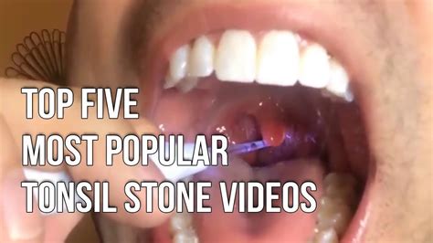 Most Popular Tonsil Stone Removal Tonsil Stone Removal Tools Youtube