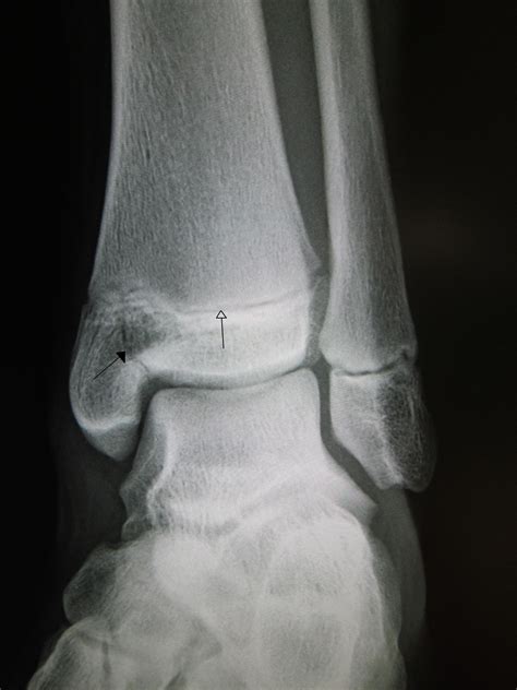 Ankle Fractures Bay Area Foot Care