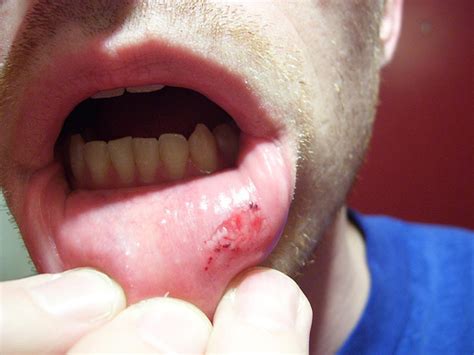 What Are Mouth Canker Sores The Basics Behind The Problem