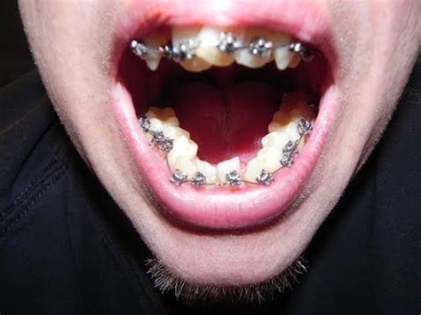 As a starting point, the night retainers are worn as long as it takes for the teeth to settle in their new position. Wear Your Retainer After Adult Braces! "Before and After ...