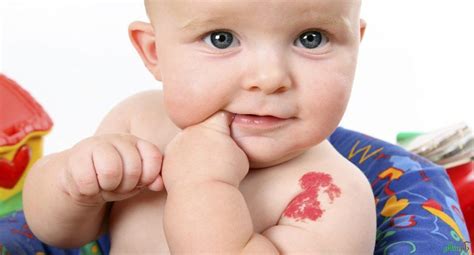 Types Of Birthmark And Why They Appear مجله پزشکی دکتر سلام سلامت