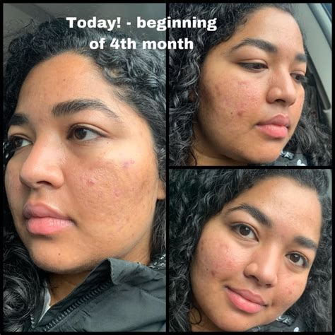 My Accutane Journey Before And Current Pictures Side Effects And