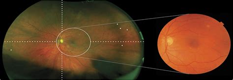 Presence Of Peripheral Lesions And Correlation To Macular Pe Retina