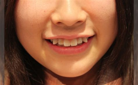 Girls With Snaggleteeth Are Cute Reflecting Japanese Cultural Tendency To Feel Affection Toward