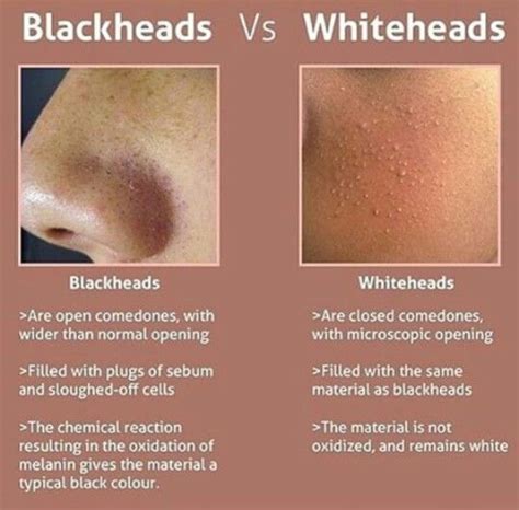 Blackheads Vs Whiteheads Whiteheadsremedy Skin Care Tips Whitehead