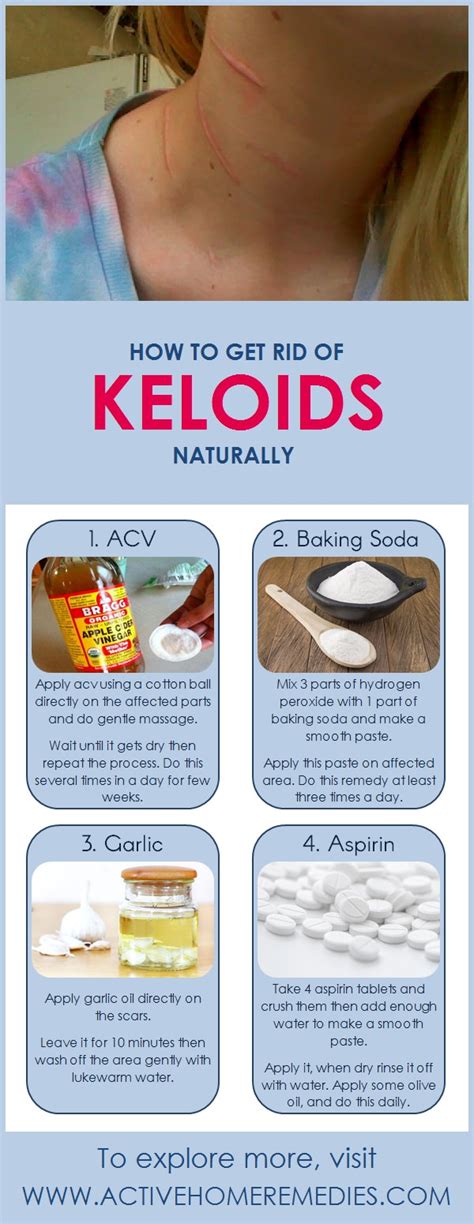 Home Remedies For Keloids Active Home Remedies