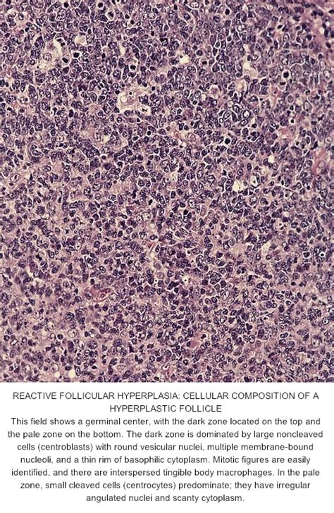 Pathology Outlines Follicular Hyperplasia