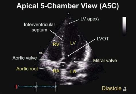 Apical 5 Chamber View Tee Cardiac Sonography Medical Ultrasound