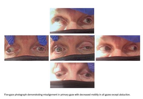 Acquired Third Nerve Palsy And A Case Of Reversed Anisocoria