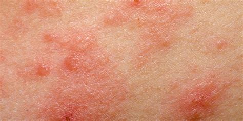 Is Eczema Contagious Heres The Absolute Truth Self
