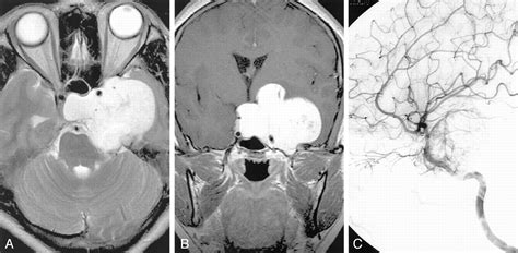 Characteristic Mr Imaging Findings Of Cavernous Hemangiomas In The