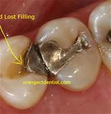Emergency Cavity Filling Pictures