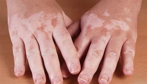 Hypopigmentation Causes Types And Treatment