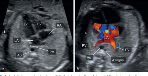 In this article, we provide a comprehensive review of ultrasound appearance of common fetal cardiac anomalies. Figure 3 from Ultrasound of the fetal veins part 2: Veins ...