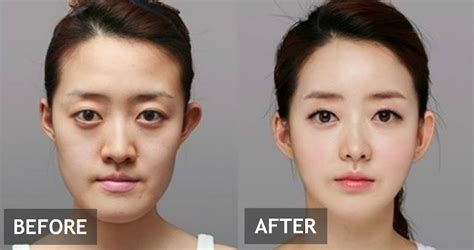 9 Most Popular Plastic Surgery Procedures In Korea Koreaboo