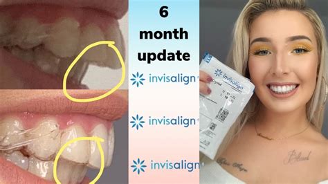 Invisalign Overbite Correction 6 Month Update With Before And After Pics Youtube