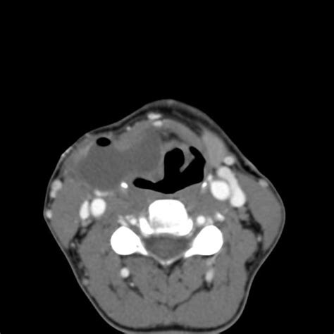 Second Branchial Cleft Cyst Neurorad911 Branchial Cyst