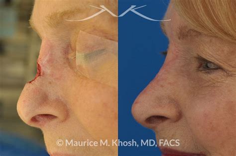Repair Of Mohs Skin Cancer Defect Of Nose Reconstruction Of Nose After