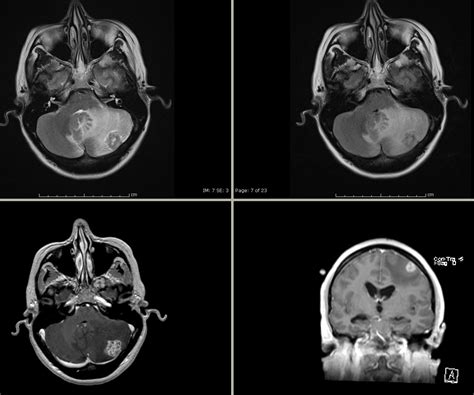 Brain Metastases Image