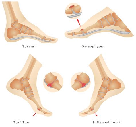 Most athletes suffering from this sports injury will recall exactly when and how the injury happened. What is turf toe? Houston Running Podiatrist | Tanglewood ...