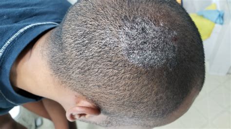Itchy Flaking White Spots On Scalp Dermatology Forums Patient