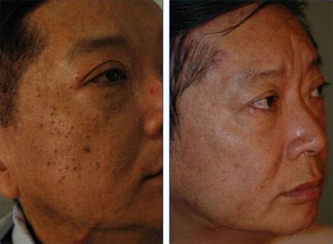This was my fourth session but first time getting these negative results. Laser Treatments for Asian Skin - Orange County and Torrance