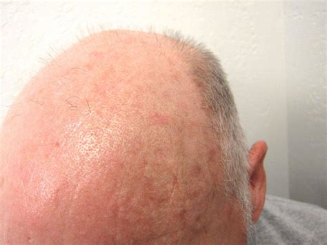 Pictures Of Actinic Keratosis Moles Nevus And Psoriasis