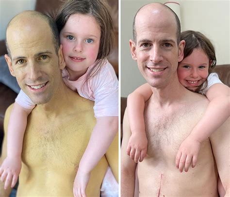 Dad Saved By Liver Transplant Shares Pictures Taken Before And After Showing His Remarkable