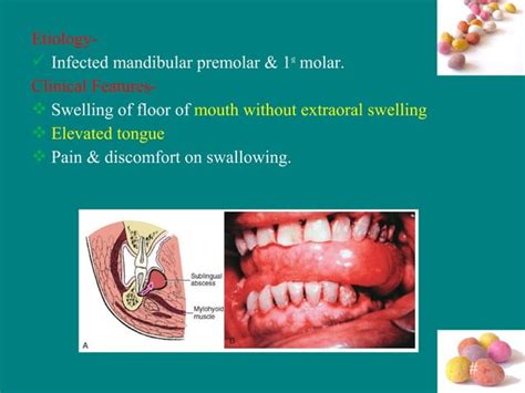 Complex Odontogenic Infections Ppt