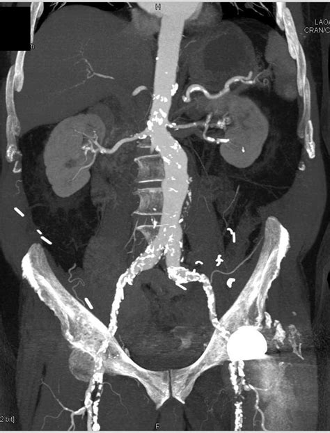 Occluded Left Femoral Artery Vascular Case Studies Ctisus Ct Scanning