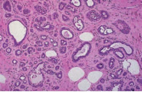 Photomicrograph Showing A Case Of Fibrocystic Change Displaying Cyst