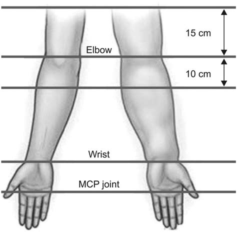 Circumferential Limb Measurement In Lymphedema Patients Adapted After