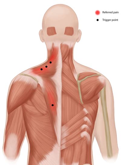 Trigger Point Injection Myofascial Pain Treatment Pain Spa Bristol Uk