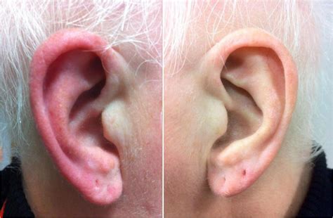 Red Ears Symptoms Causes And Treatment