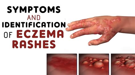 Symptoms And Identification Of Different Types Of Eczema Rashes Youtube