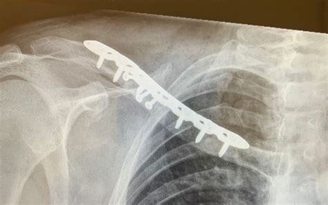 4 Lessons From A Surgeons Clavicle Surgery “the Other Side Of The