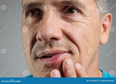 Allergic Reaction On A Man S Lip After A Bee Sting Stock Image Image