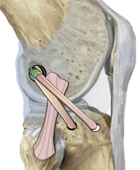 Anterolateral Ligament Reconstruction And Modified Lemaire Lateral